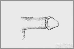 包皮手术费用包含哪些